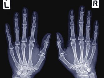 hand xray