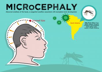 zika microcephaly