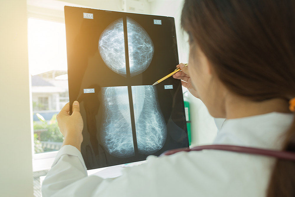 shutterBreast Cancer Mammogram 