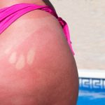 What to Do When You Have a Sunburn