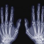$10 Screening for Osteoporosis