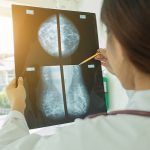What You Need to Know About Mammograms