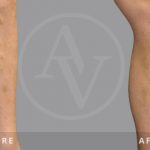 Now Is the Time for Sclerotherapy!
